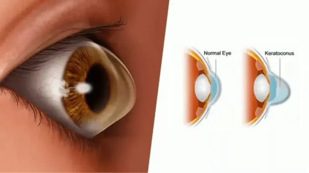 هوش مصنوعی در تشخیص کراتوکونوس